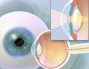 What Are Phakic Intraocular Lenses?