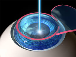 Laser Eye Surgery Is it right for you