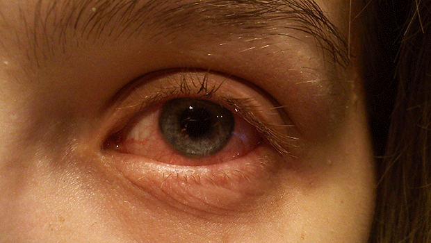 eye_conditions