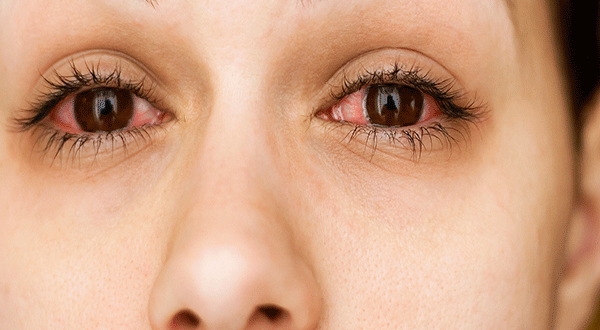 Eye_allergies